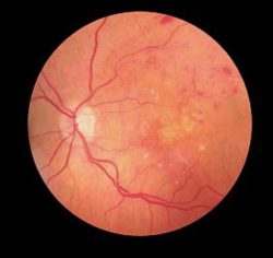 Retina Showing Diabetic Retinopathy